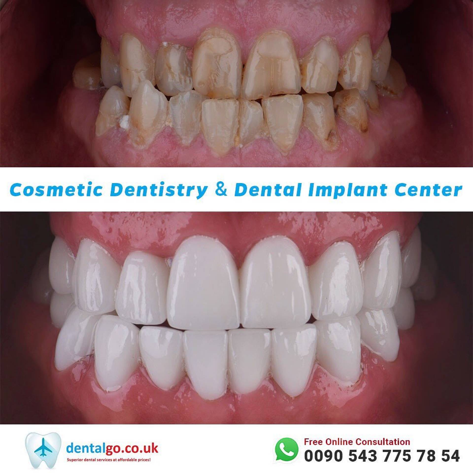 Dental smile perfection with zirconia crowns