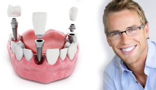 How To Get Low Cost, Affordable Dental Implants  Abroad