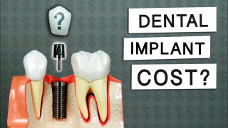 Cheap Dental Implants, Affordoble Way To Get A Complete Smile