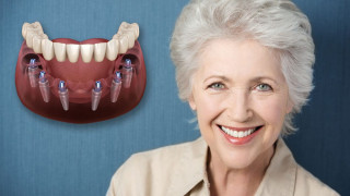 All-on-6 Dental Implants in Turkey: Everything You Need to Know