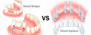 Dental Implants vs Dentures: Which is Right for You?