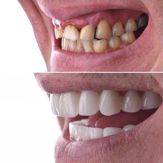 Get Your Perfect Smile At the Best Dental Clinic In Antalya Turkey