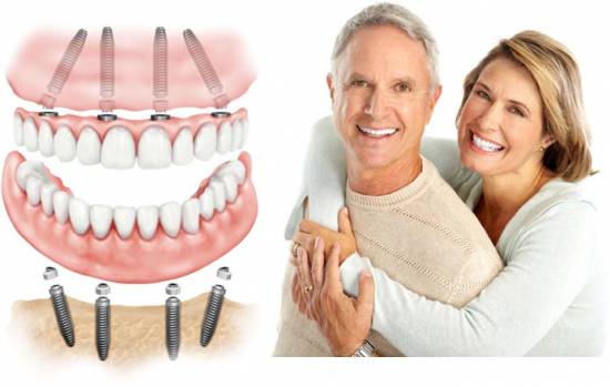 All On 4 Dental Implants In Turkey - The best dental implant clinic in Turkey